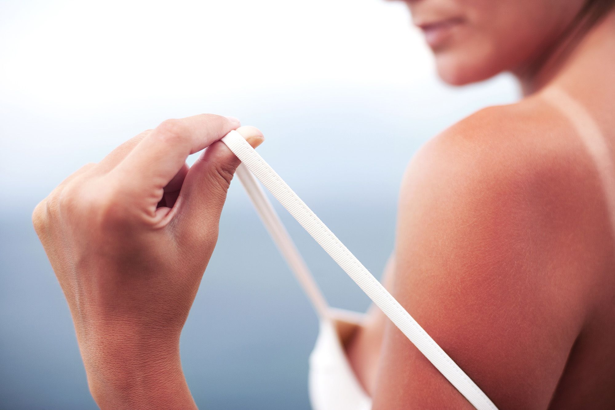 alergija na sonce, fotodermatoza
