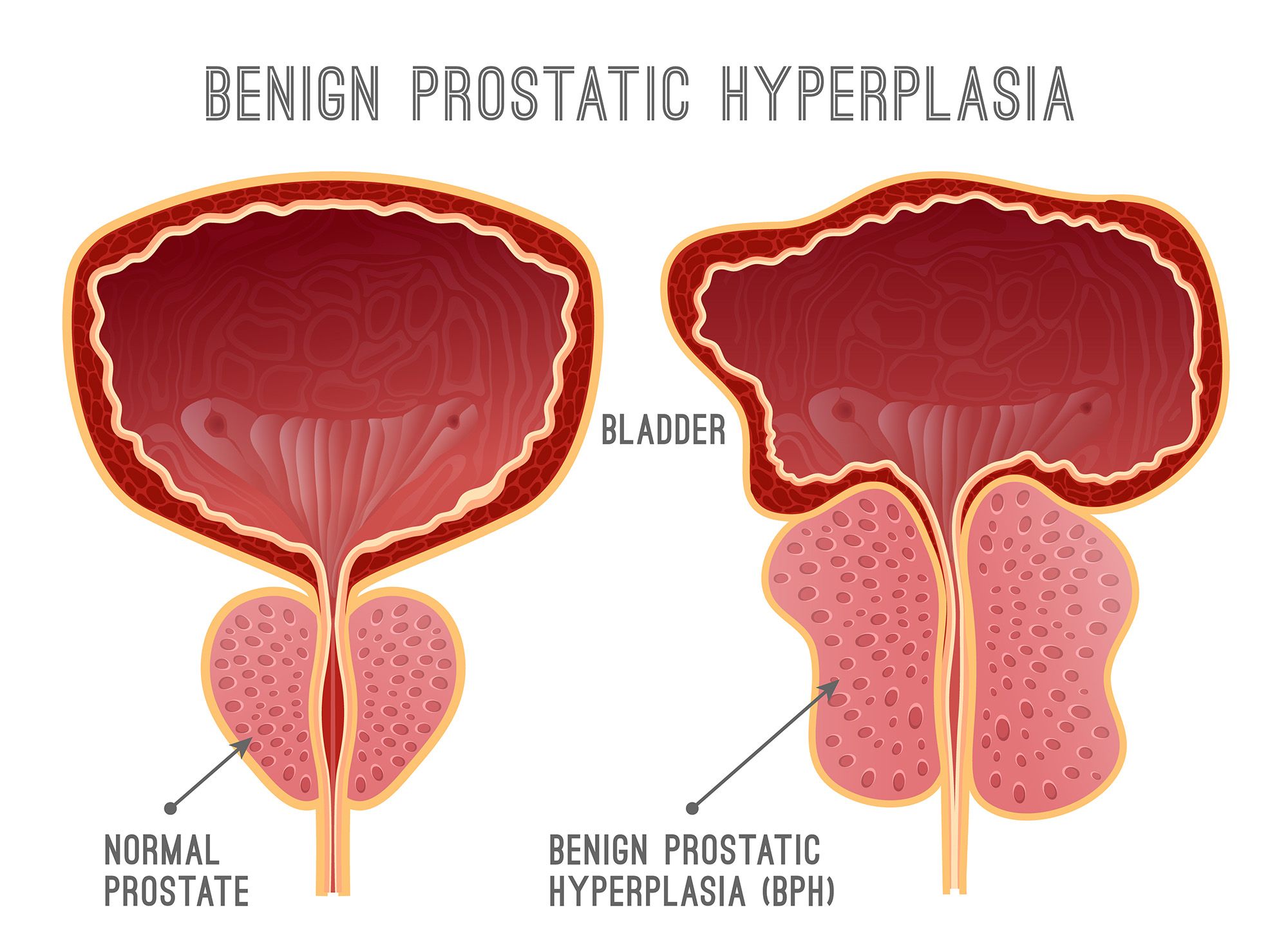 2 Povecana Prostata