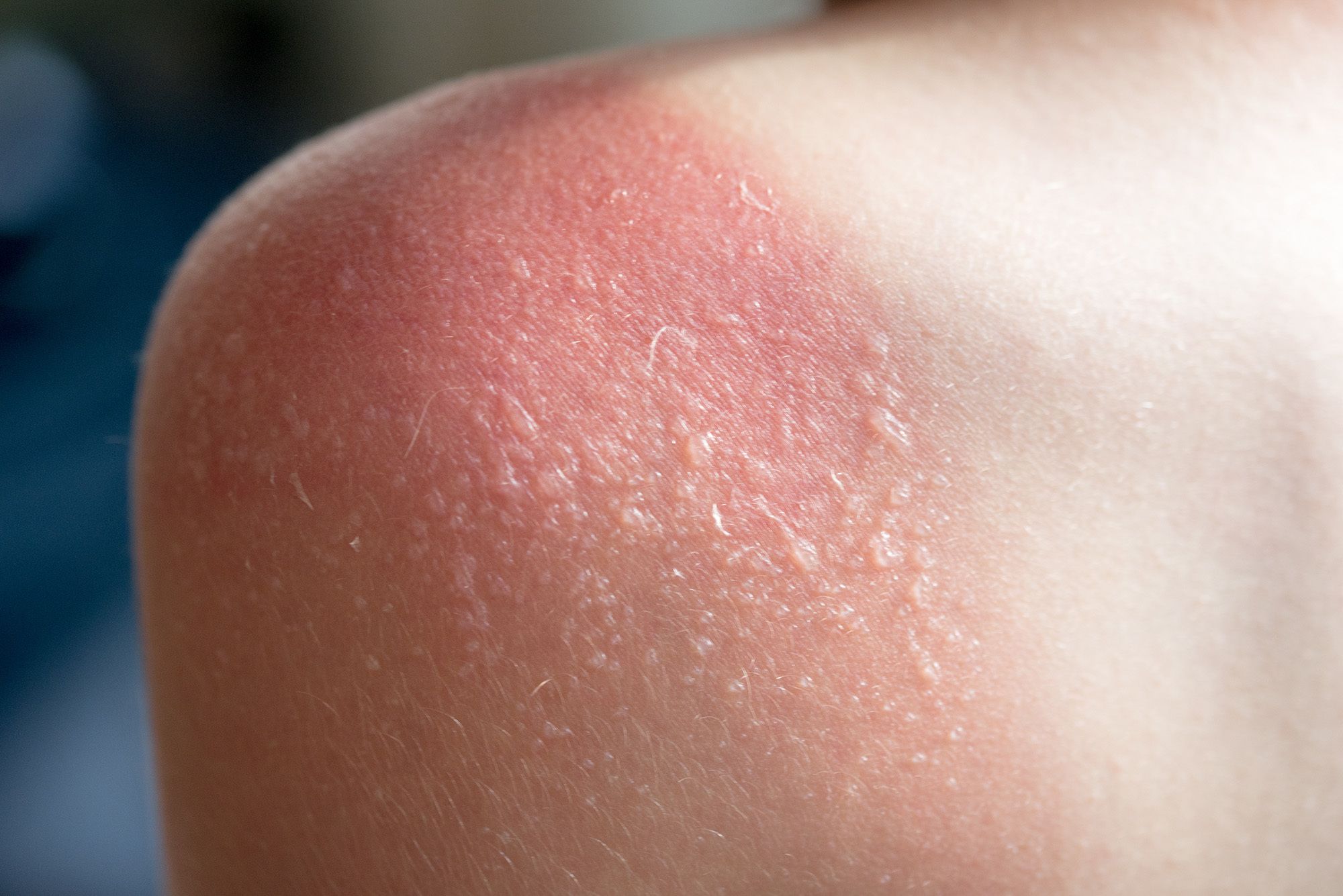 Alergija na sonce, fotodermatoza