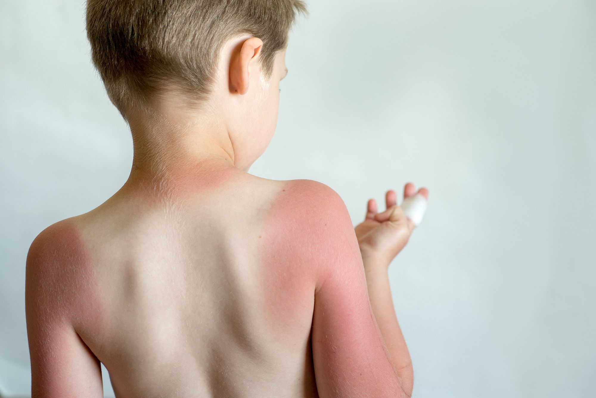 otroci, alergija na sonce