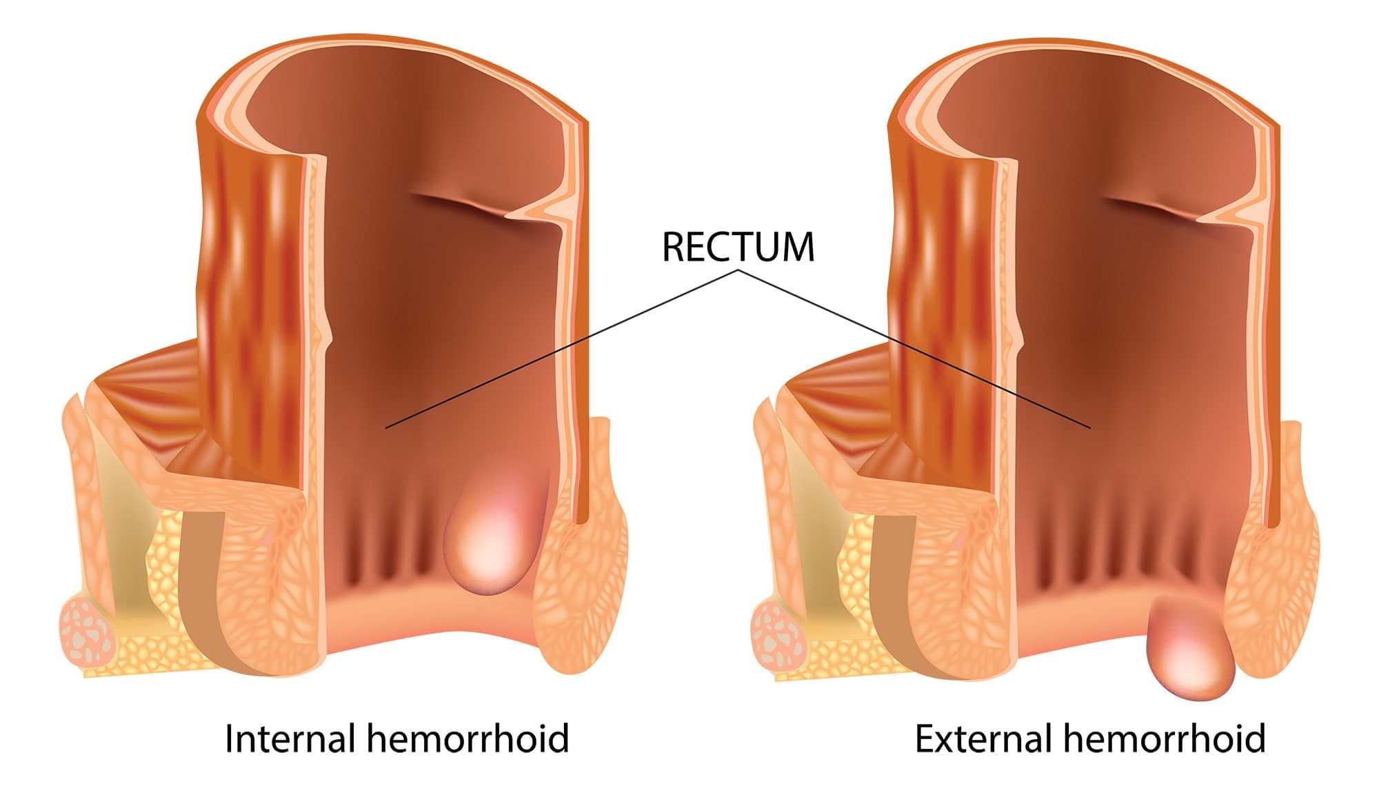 hemoroidi, notranji, zunanji